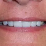 Veneers after