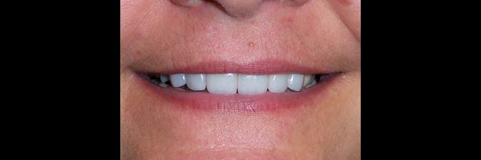 Veneers after
