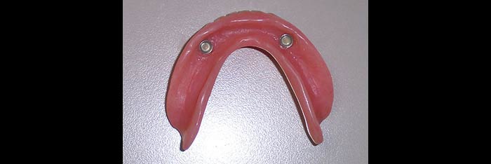 Lower Denture