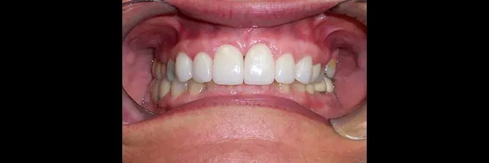 Veneers after