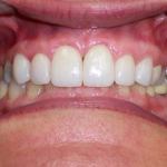 Veneers after