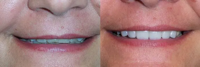 Veneers Before and After