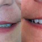 Veneers Before and After