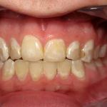 Veneers before