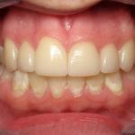 Veneers after