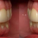 Veneers after