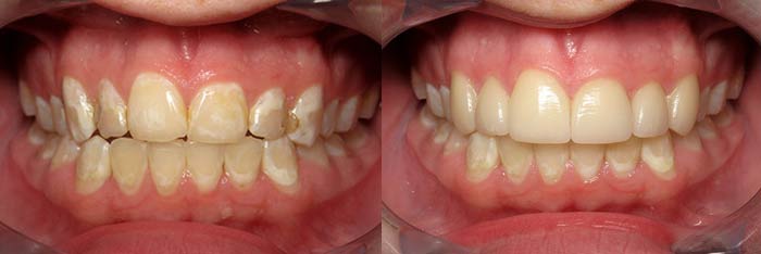 Veneers Before and After