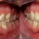 Veneers Before and After