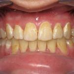 Veneers before