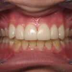 Veneers after