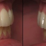 Veneers after