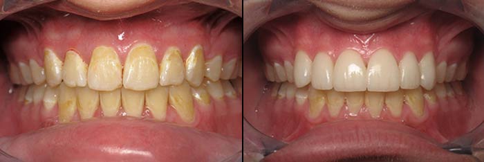 Veneers Before and After