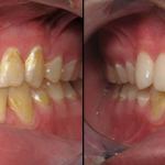 Veneers Before and After