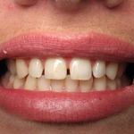 Veneers before