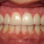 Veneers after