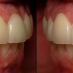 Veneers after