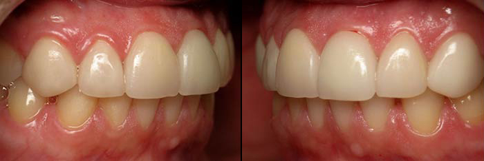 Veneers after