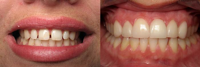 Veneers Before and After