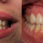 Veneers Before and After