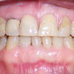 Veneers before