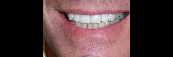 Veneers after