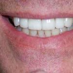 Veneers after