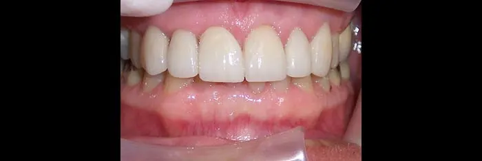 Veneers after