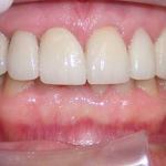 Veneers after