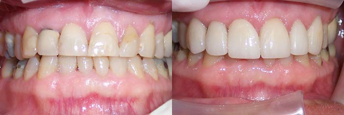 Veneers Before and After