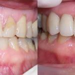 Veneers Before and After