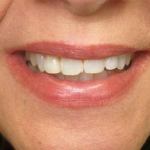 Veneers before