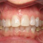Veneers before