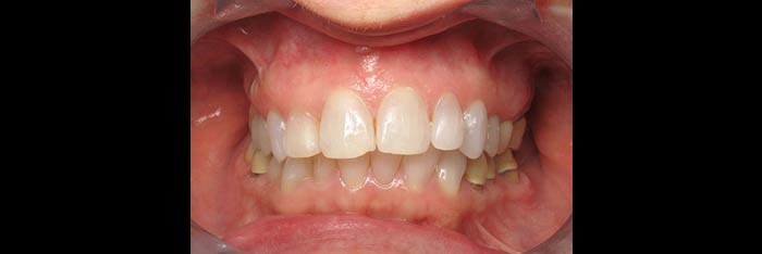 Veneers before