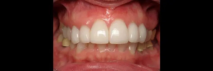 Veneers after