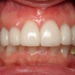 Veneers after