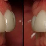 Veneers after