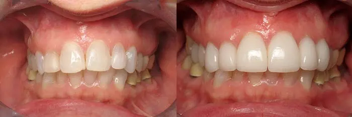 Veneers Before and After