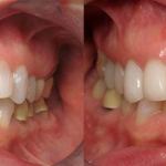 Veneers Before and After